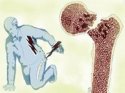 草莓视频黄色成人检测仪教你预防骨质疏松性骨折