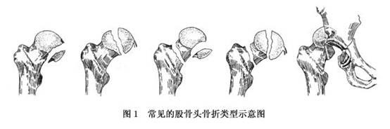 股骨头草莓视频黄色成人增加是什么意思？平睡左腿收起左右摆动大点大腿根就痛。