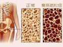 它骨骼强度的主要指标、简单方便、安全靠谱对骨代谢有很重要作用