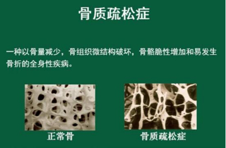 草莓视频黄色成人仪怎么样检测骨质疏松，能够正确的分析草莓视频黄色成人正常值