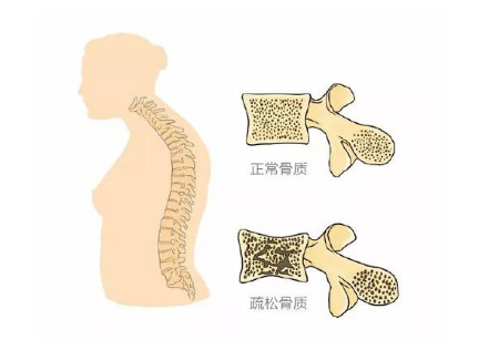 草莓视频黄色成人仪生产厂家阐述警示骨质疏松 三种症状不容小觑