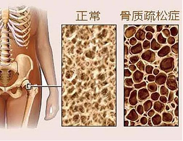 骨质疏松测草莓视频黄色成人仪器有哪些种类?不同种类的特点对比