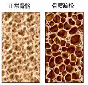 草莓视频黄色成人检测仪生产厂家骨质疏松老年人疾病年轻人需要做草莓视频黄色成人检测吗