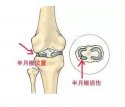 624河南信阳|草莓影院网站超声波草莓视频黄色成人仪厂家今日资讯：了解并正确保护膝关节半月板