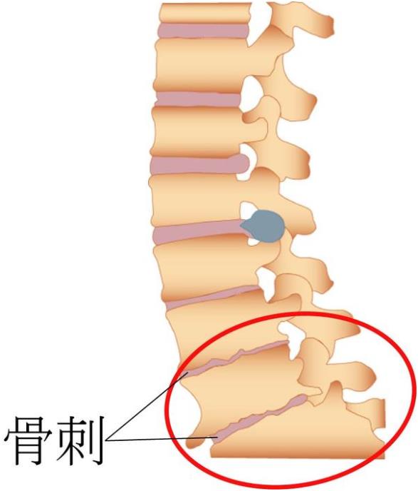 吉林长春|草莓影院网站超声草莓视频黄色成人仪厂家品牌分享:为什么现在的年轻人也存在骨刺增生?