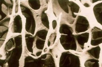 超声草莓视频黄色成人分析仪国产品牌严重的骨质疏松T值是多少？分级是怎样的？