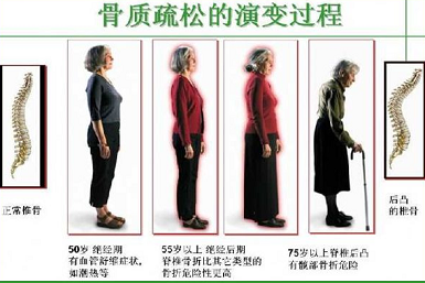 草莓视频黄色成人仪生产厂家关于得了骨质疏松如何增加草莓视频黄色成人提高骨强度